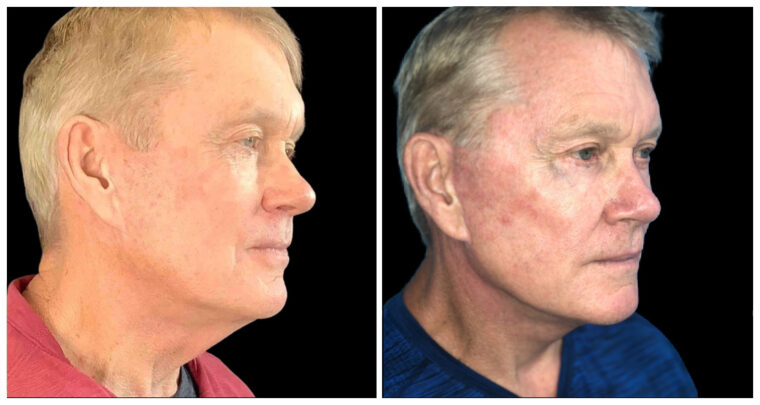 Before and after front view of a face lift
