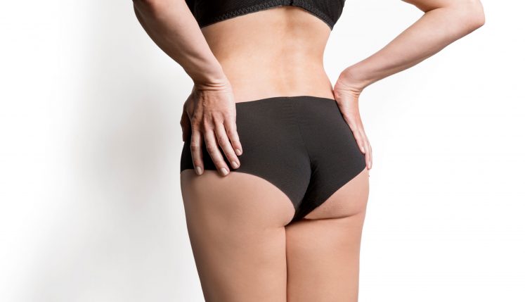 A patient stands with hands on hips in black underwear, showing the lower back and buttocks in a discussion of buttock augmentation and implants.