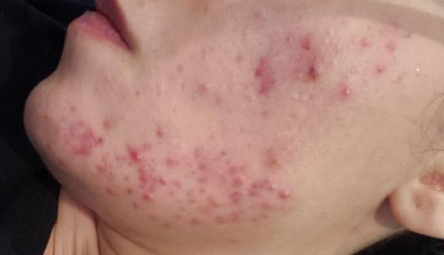 Acne breakouts with clustered red pimples and inflamed bumps cover the chin and cheek, reflecting the anatomy of acne discussed in the article.