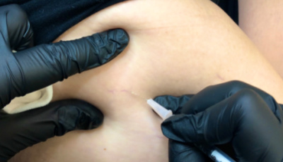 Close-up of a person's abdomen with gloved hands performing a procedure, using a tool to mark the skin.