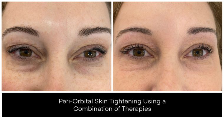Before and after images of peri-orbital skin tightening treatment showing improved appearance around the eyes.