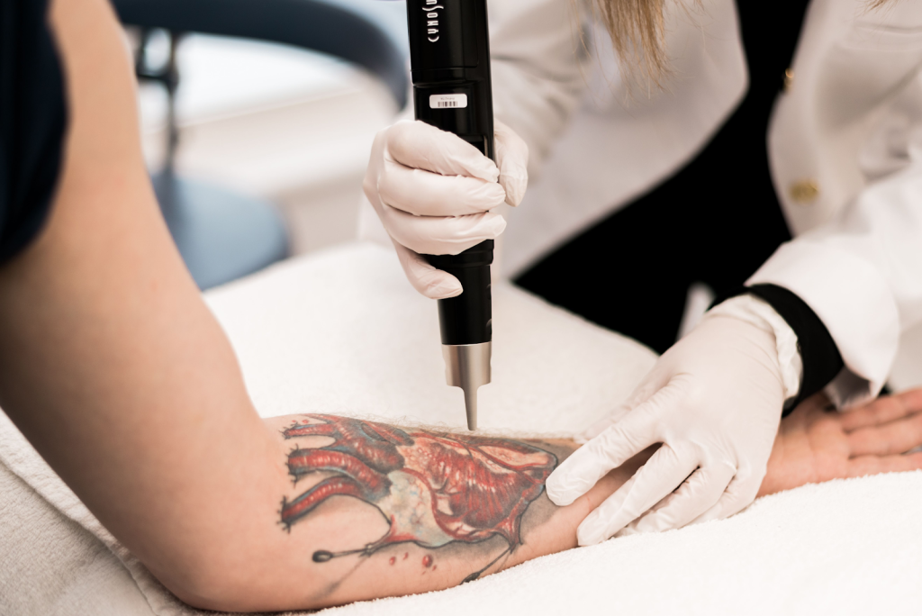 Does laser tattoo removal leave scars?